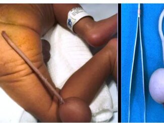 Bebê brasileiro nasce com cauda de 12 cm e bola de 4 cm na extremidade