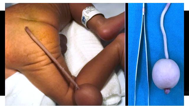 Bebê brasileiro nasce com cauda de 12 cm e bola de 4 cm na extremidade
