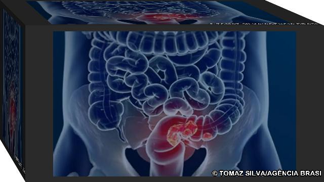 Estudo projeta aumento de 36% em mortes por câncer colorretal até 2040